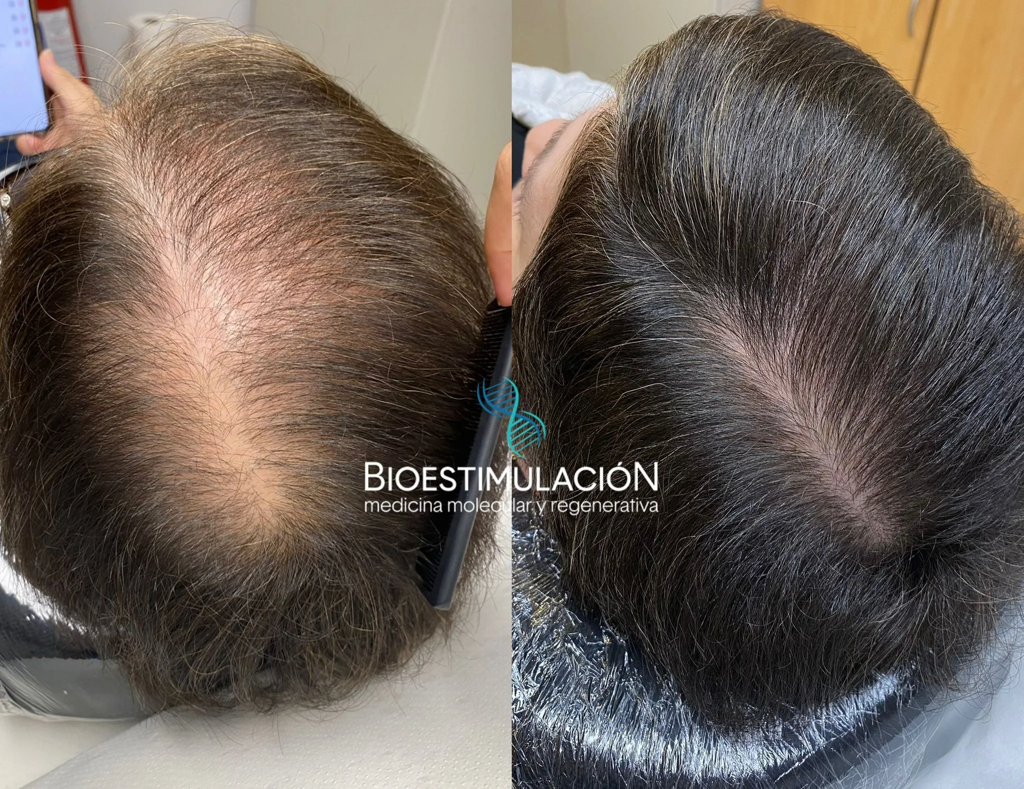 Regenera Activa - Bioestimulación